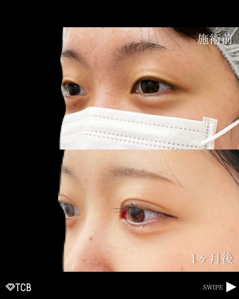 二重埋没法(担当医:古市 吉真 医師)の症例写真2