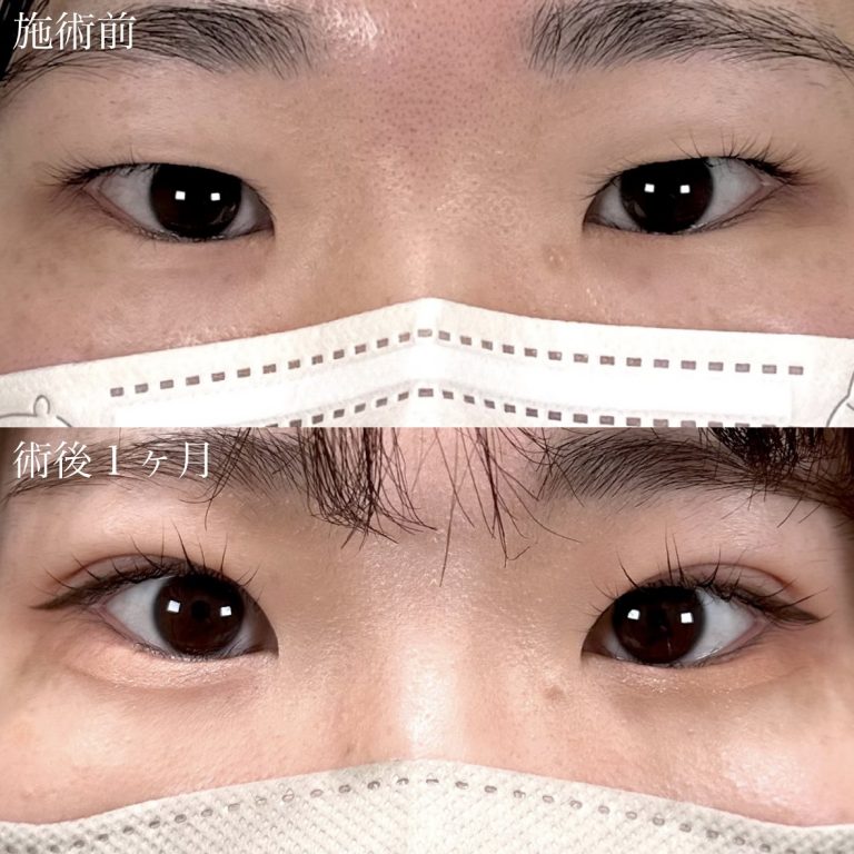 二重埋没法(担当医:奥村 瞬 医師)の症例写真1