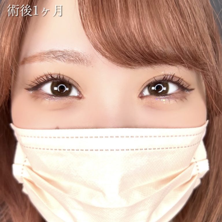 二重埋没法(担当医:川島 康弘 医師)の症例写真1