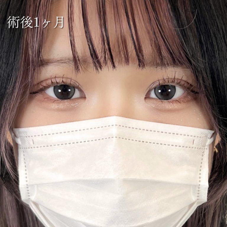 二重埋没法(担当医:川島 康弘 医師)の症例写真1