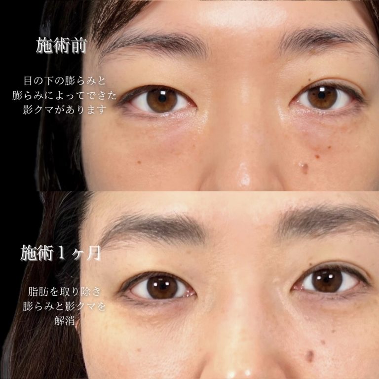 切らない目の下のクマ取り・目の下のたるみ（ふくらみ）取り(担当医:川島 康弘 医師)の症例写真4