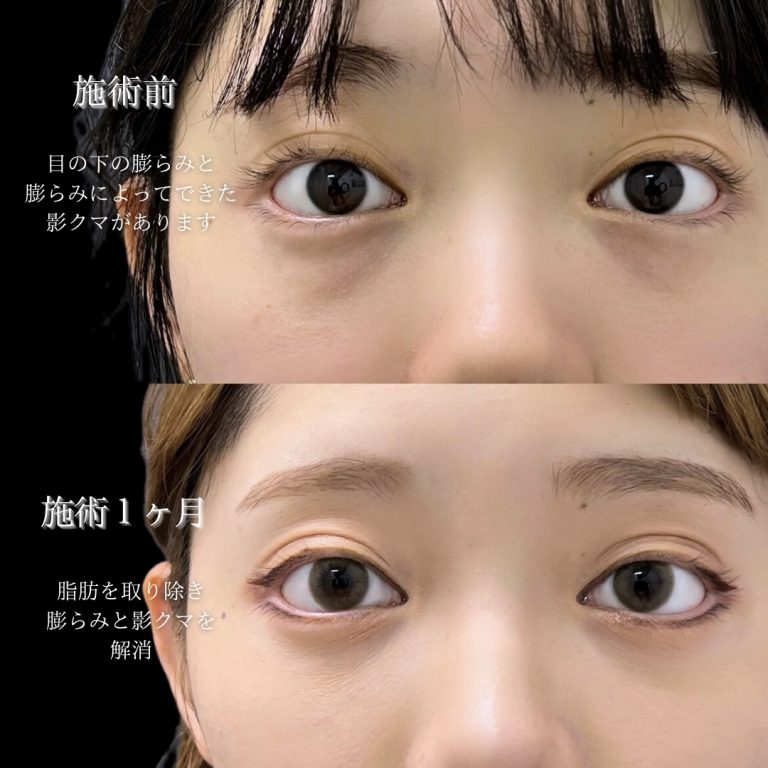 切らない目の下のクマ取り・目の下のたるみ（ふくらみ）取り(担当医:川島 康弘 医師)の症例写真2