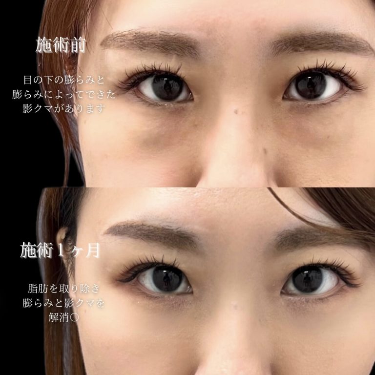 切らない目の下のクマ取り・目の下のたるみ（ふくらみ）取り(担当医:川島 康弘 医師)の症例写真2