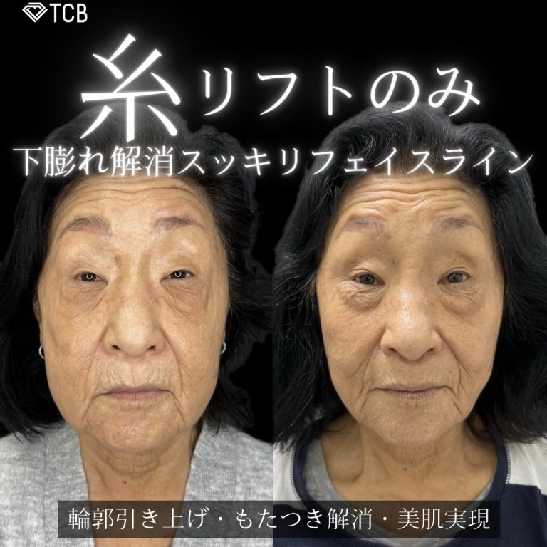 小顔美肌再生（リフトアップ）(担当医:川島 康弘 医師)の症例写真1
