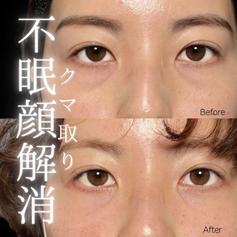 切らない目の下のクマ取り・目の下のたるみ（ふくらみ）取り(担当医:川島 康弘 医師)の症例写真1