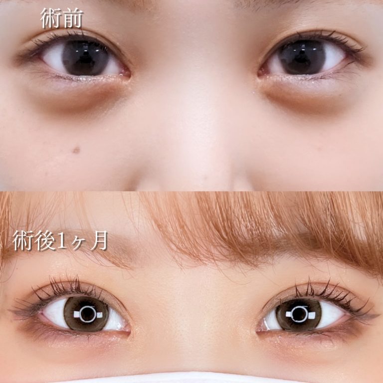 二重埋没法(担当医:川島 康弘 医師)の症例写真4