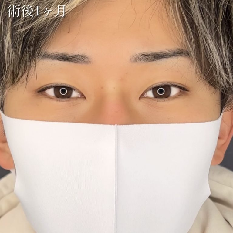 二重埋没法(担当医:川島 康弘 医師)の症例写真1