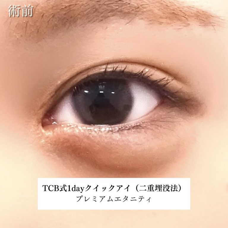 二重埋没法(担当医:川島 康弘 医師)の症例写真2