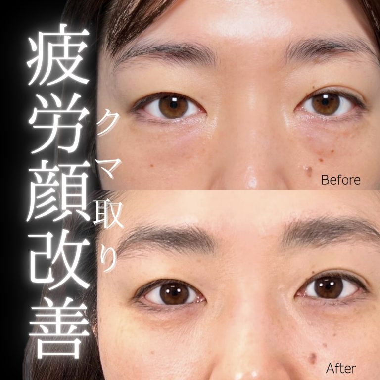 切らない目の下のクマ取り・目の下のたるみ（ふくらみ）取り(担当医:川島 康弘 医師)の症例写真1
