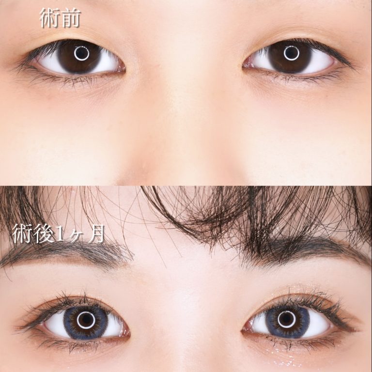 二重埋没法(担当医:川島 康弘 医師)の症例写真4