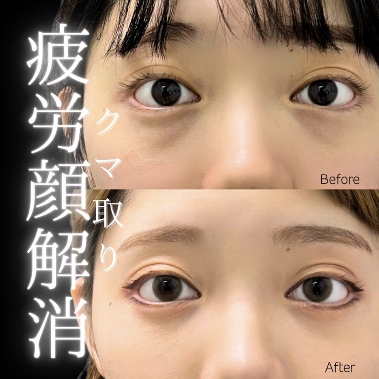 切らない目の下のクマ取り・目の下のたるみ（ふくらみ）取り(担当医:川島 康弘 医師)の症例写真1