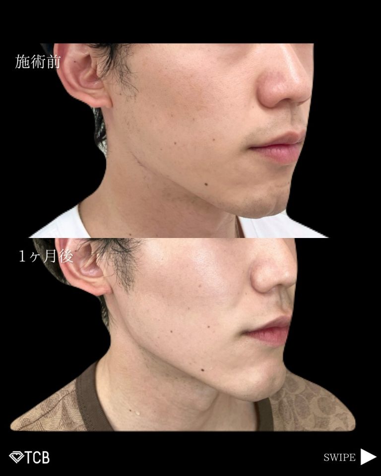 小顔美肌再生（リフトアップ）(担当医:古市 吉真 医師)の症例写真1