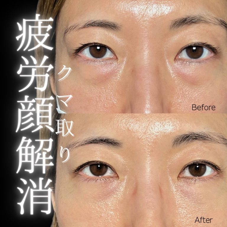 切らない目の下のクマ取り・目の下のたるみ（ふくらみ）取り(担当医:川島 康弘 医師)の症例写真1