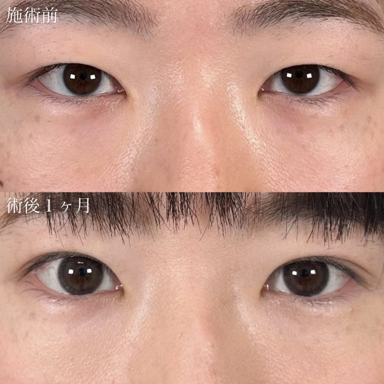 二重埋没法(担当医:奥村 瞬 医師)の症例写真1