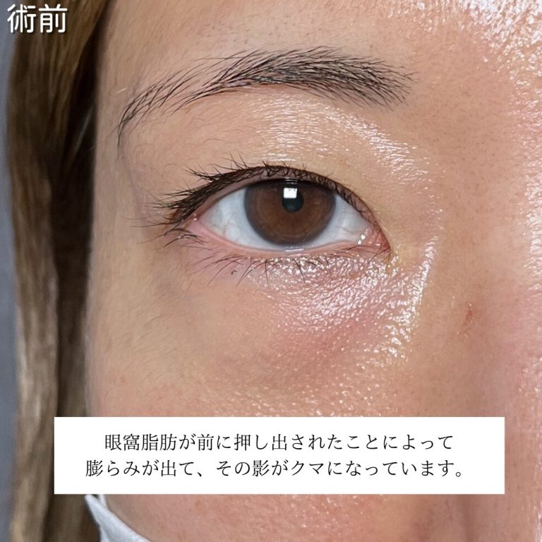 切らない目の下のクマ取り・目の下のたるみ（ふくらみ）取り(担当医:川島 康弘 医師)の症例写真2
