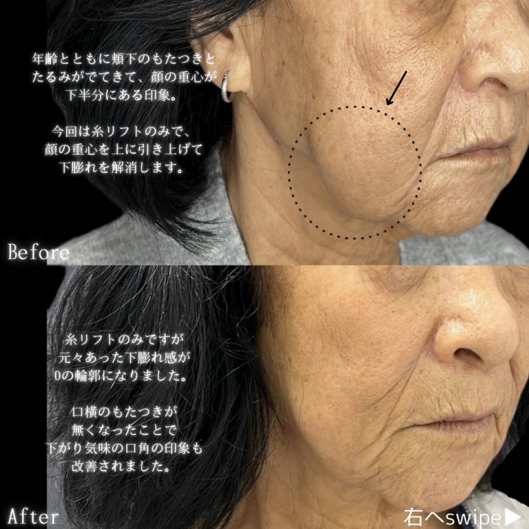 小顔美肌再生（リフトアップ）(担当医:川島 康弘 医師)の症例写真3