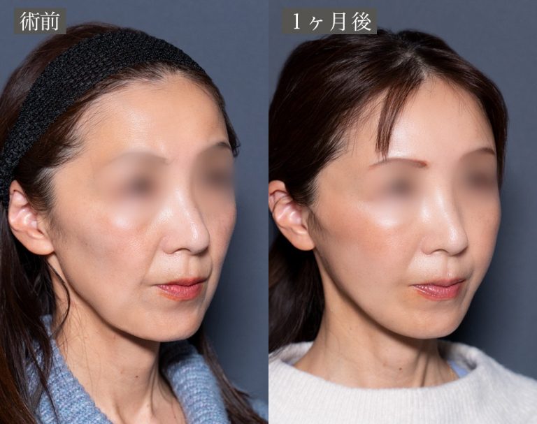 小顔美肌再生（リフトアップ）(担当医:岡本 卓也 医師)の症例写真2
