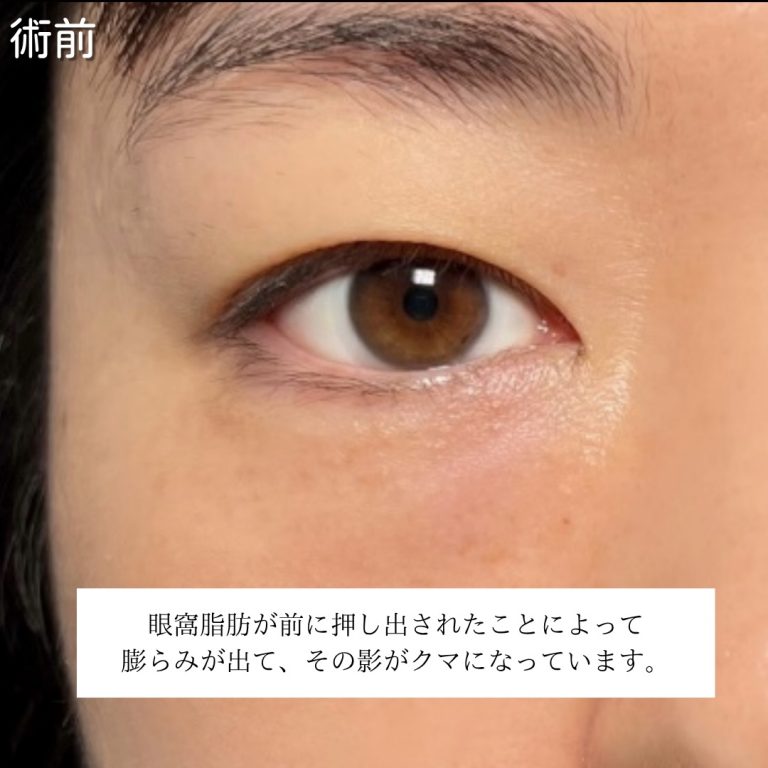 切らない目の下のクマ取り・目の下のたるみ（ふくらみ）取り(担当医:川島 康弘 医師)の症例写真2