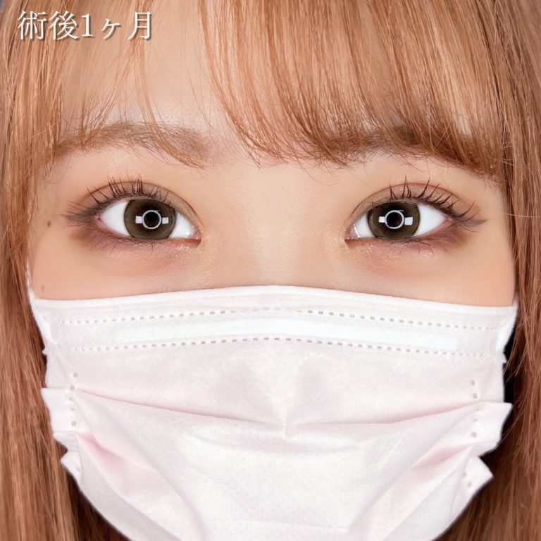 二重埋没法(担当医:川島 康弘 医師)の症例写真1