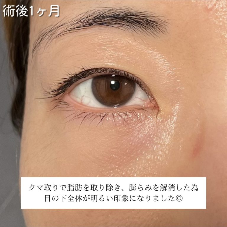 切らない目の下のクマ取り・目の下のたるみ（ふくらみ）取り(担当医:川島 康弘 医師)の症例写真3