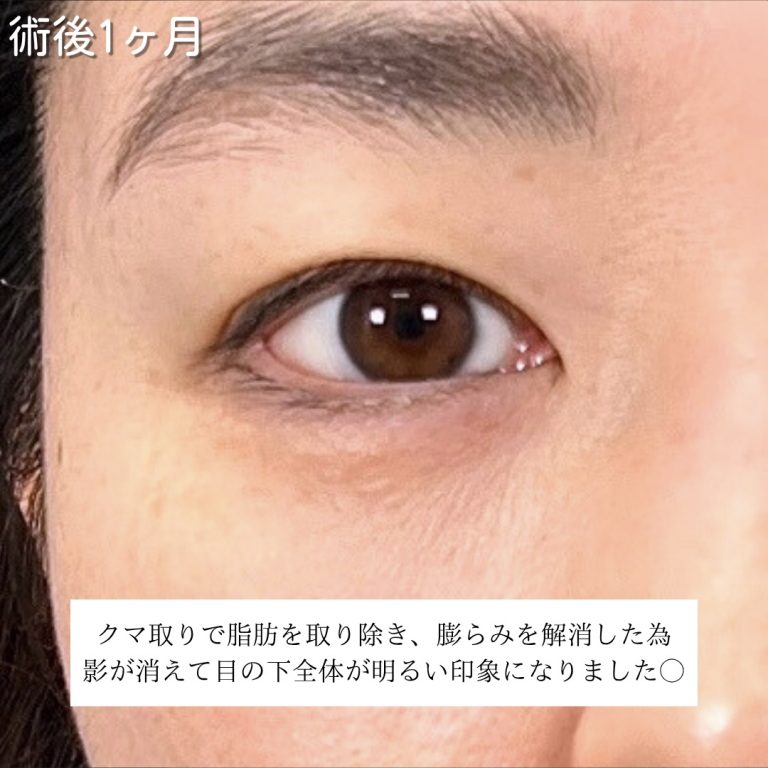 切らない目の下のクマ取り・目の下のたるみ（ふくらみ）取り(担当医:川島 康弘 医師)の症例写真3