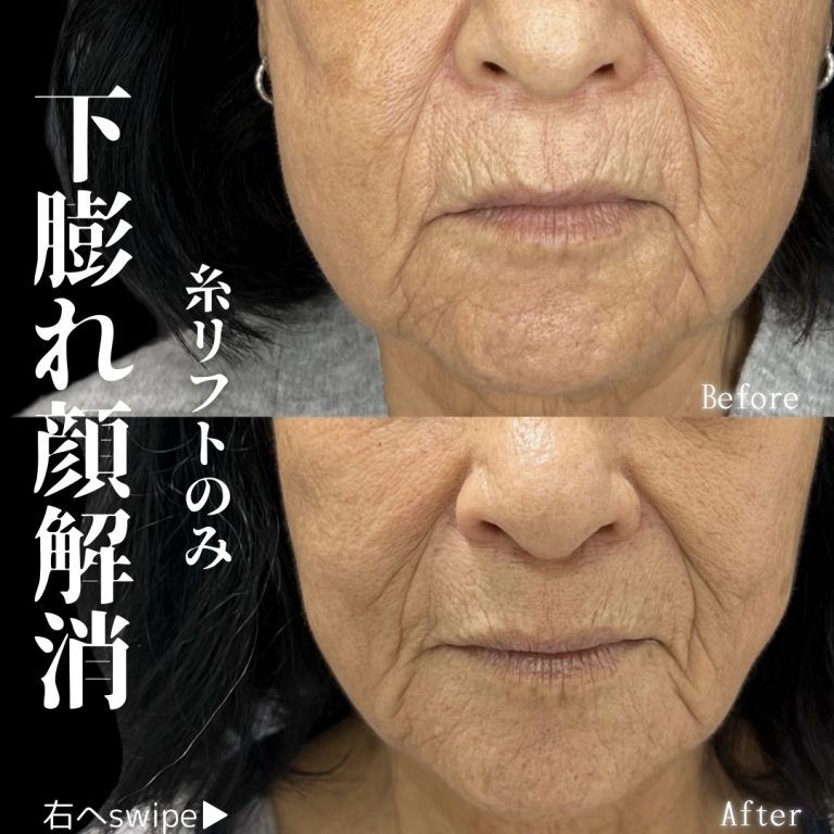 小顔美肌再生（リフトアップ）(担当医:川島 康弘 医師)の症例写真2