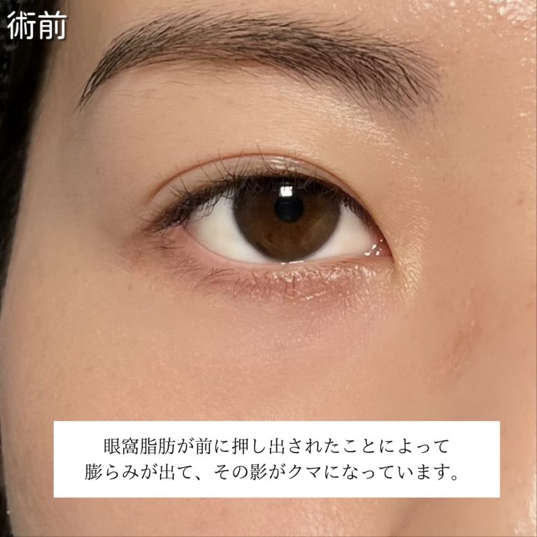 切らない目の下のクマ取り・目の下のたるみ（ふくらみ）取り(担当医:川島 康弘 医師)の症例写真2