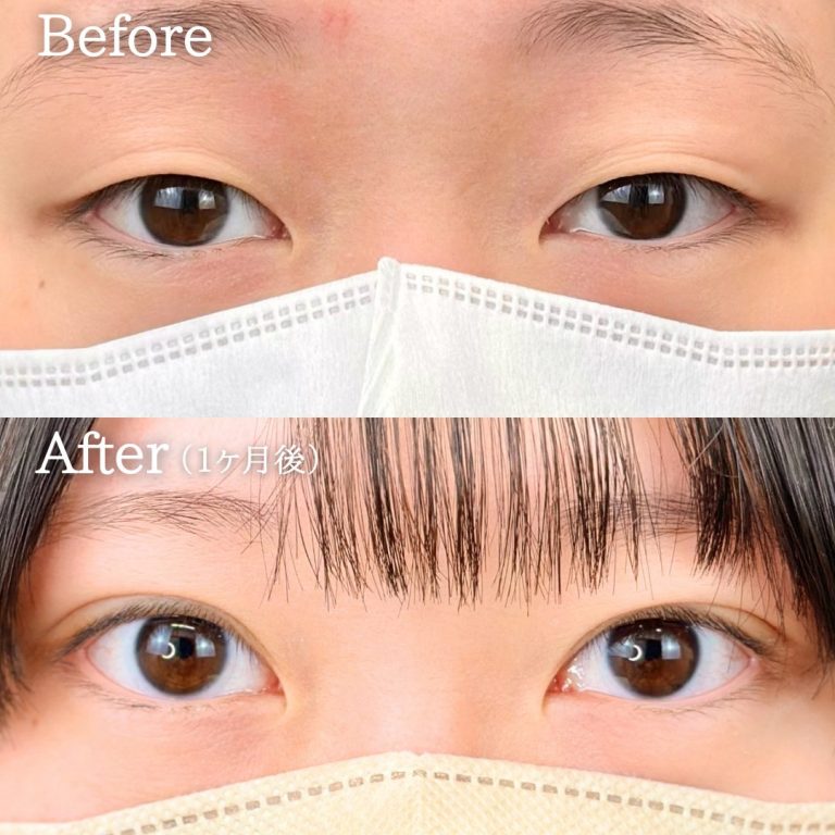二重埋没法(担当医:丁 強 医師)の症例写真1