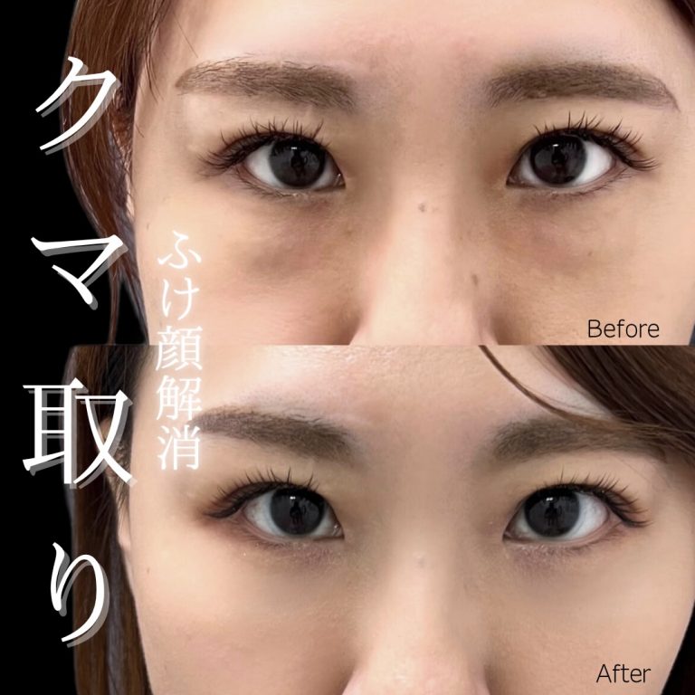 切らない目の下のクマ取り・目の下のたるみ（ふくらみ）取り(担当医:川島 康弘 医師)の症例写真1