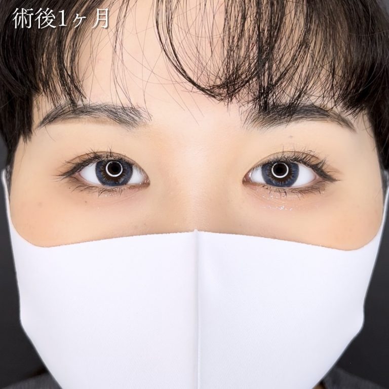 二重埋没法(担当医:川島 康弘 医師)の症例写真1