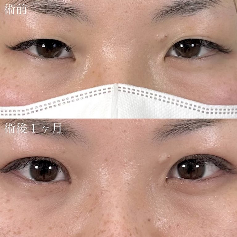 二重埋没法(担当医:奥村 瞬 医師)の症例写真1