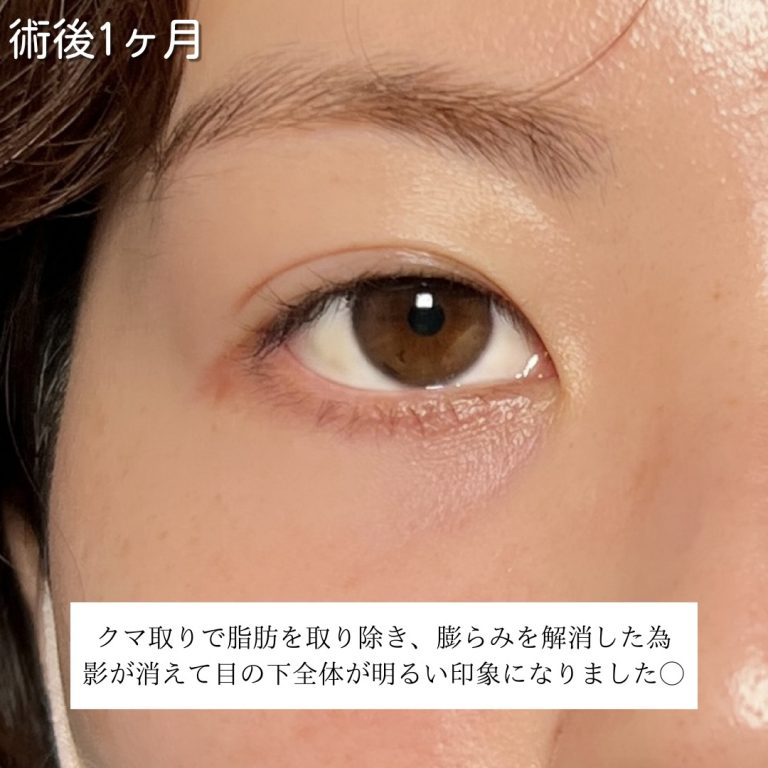 切らない目の下のクマ取り・目の下のたるみ（ふくらみ）取り(担当医:川島 康弘 医師)の症例写真3