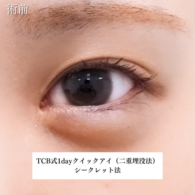 二重埋没法(担当医:川島 康弘 医師)の症例写真2