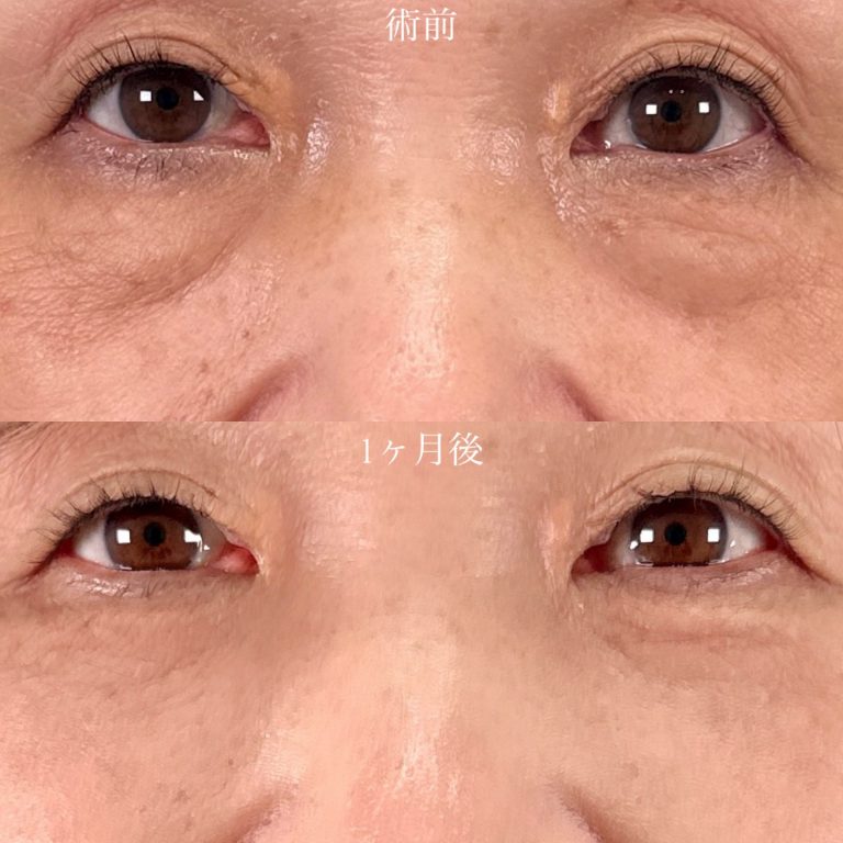 切らない目の下のクマ取り・目の下のたるみ（ふくらみ）取り(担当医:山口 征大 医師)の症例写真1