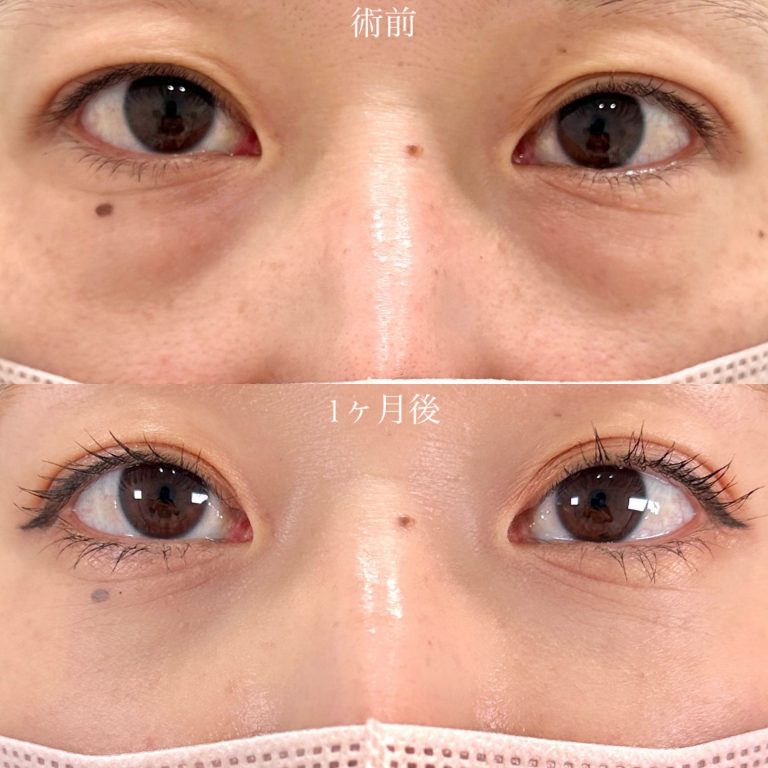切らない目の下のクマ取り・目の下のたるみ（ふくらみ）取り(担当医:山口 征大 医師)の症例写真1