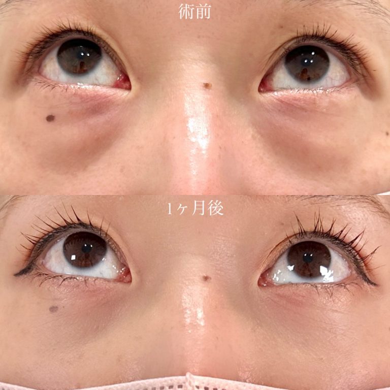 切らない目の下のクマ取り・目の下のたるみ（ふくらみ）取り(担当医:山口 征大 医師)の症例写真2