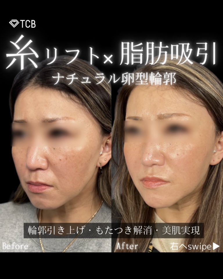 小顔美肌再生（リフトアップ）(担当医:川島 康弘 医師)の症例写真2