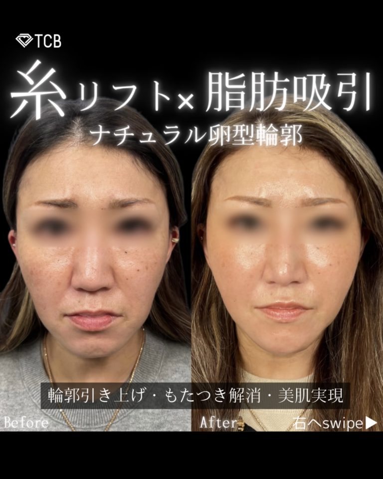 小顔美肌再生（リフトアップ）(担当医:川島 康弘 医師)の症例写真1