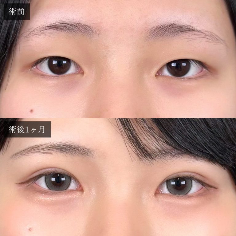 二重埋没法(担当医:渡邉 正士 医師)の症例写真1