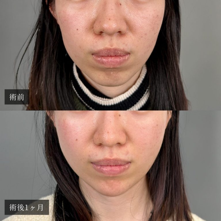 小顔美肌再生（リフトアップ）(担当医:渡邉 正士 医師)の症例写真1