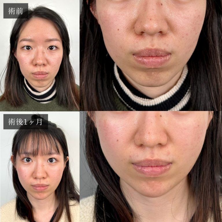 小顔美肌再生（リフトアップ）(担当医:渡邉 正士 医師)の症例写真2