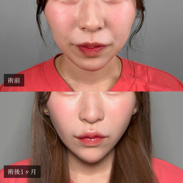 小顔美肌再生（リフトアップ）(担当医:渡邉 正士 医師)の症例写真1