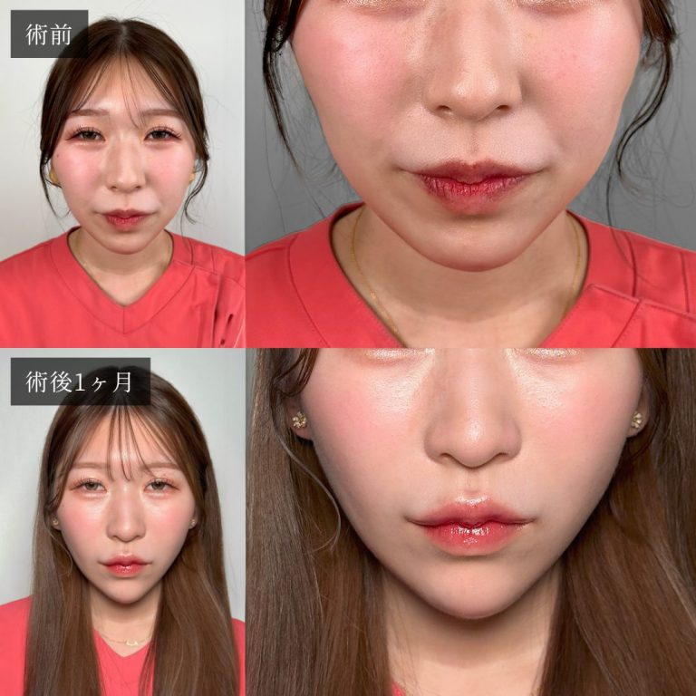小顔美肌再生（リフトアップ）(担当医:渡邉 正士 医師)の症例写真2