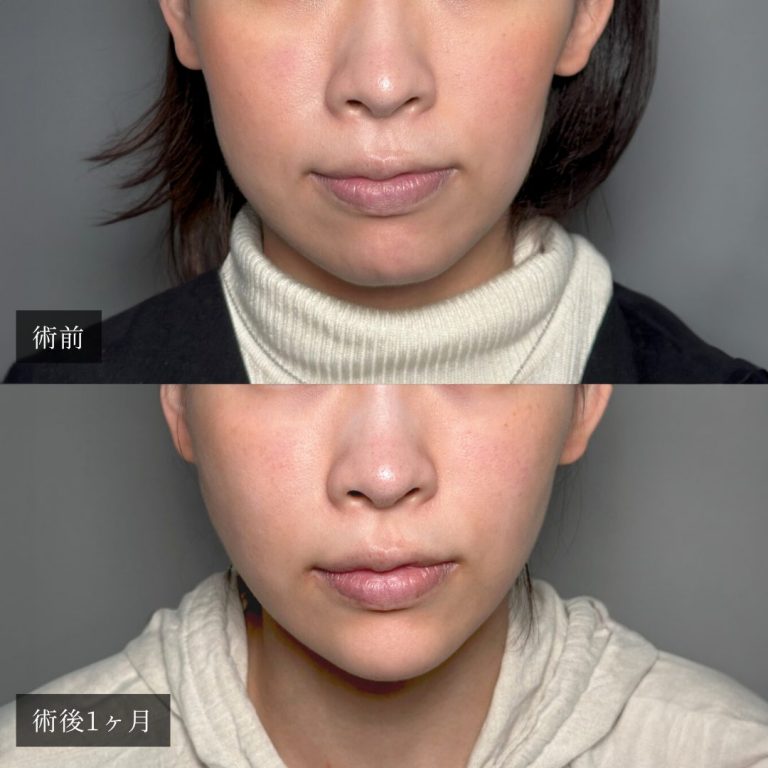 小顔美肌再生（リフトアップ）(担当医:渡邉 正士 医師)の症例写真1