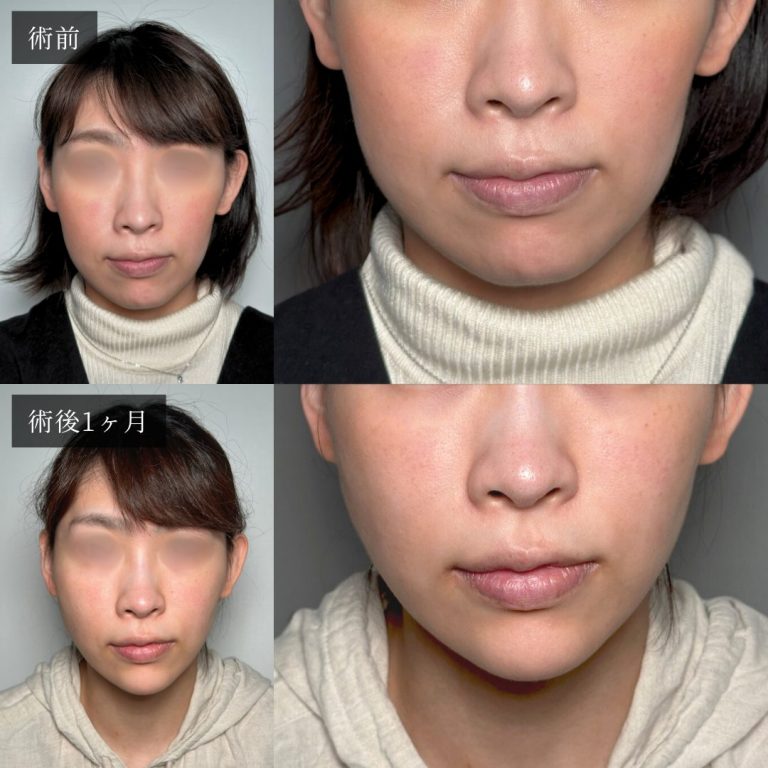 小顔美肌再生（リフトアップ）(担当医:渡邉 正士 医師)の症例写真2