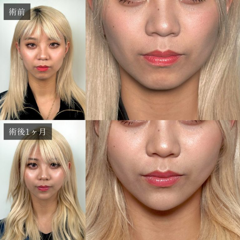 小顔美肌再生（リフトアップ）(担当医:渡邉 正士 医師)の症例写真2