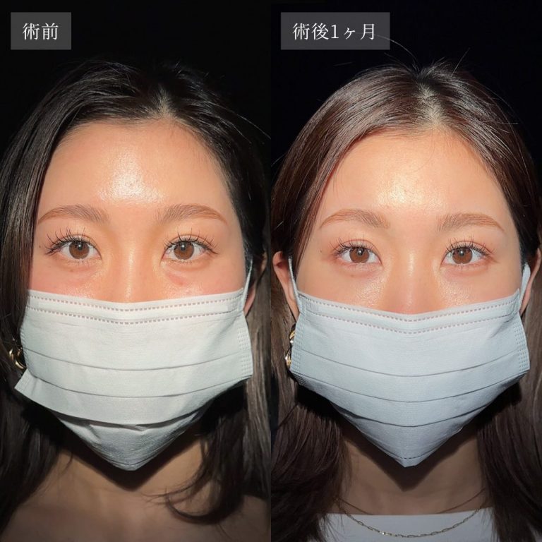 切らない目の下のクマ取り・目の下のたるみ（ふくらみ）取り(担当医:渡邉 正士 医師)の症例写真2
