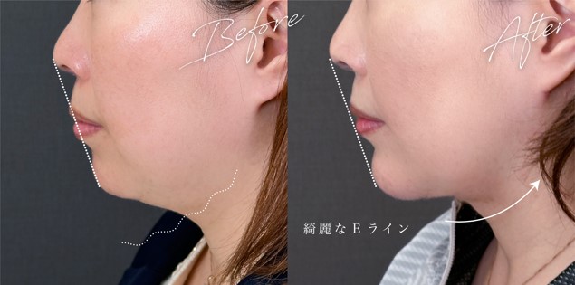 顎（あご）のヒアルロン酸注射(担当医:岡本 卓也 医師)の症例写真1