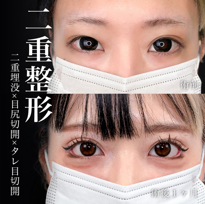 グラマラスライン形成（たれ目形成）(担当医:岡本 卓也 医師)の症例写真1