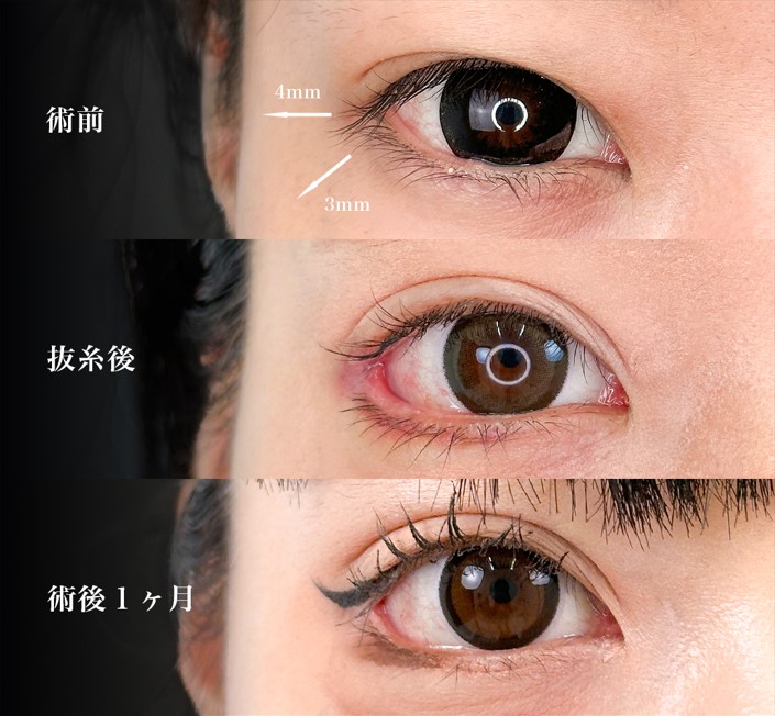 グラマラスライン形成（たれ目形成）(担当医:岡本 卓也 医師)の症例写真2